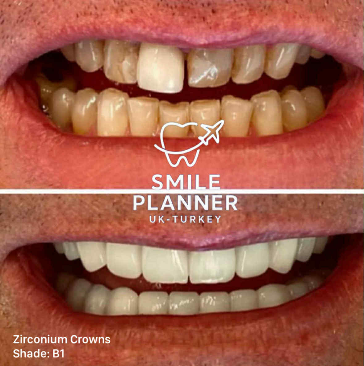 smile transformation crowns